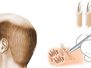 5 things you must know before hair transplant