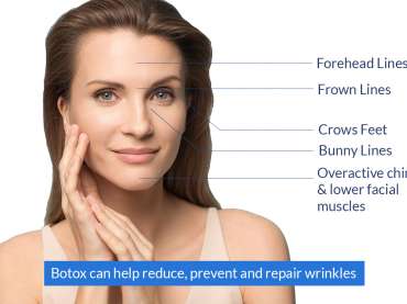 Botox for wrinkless